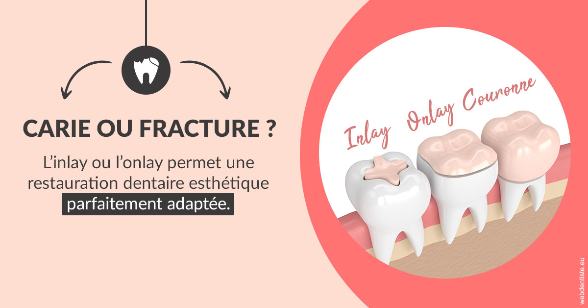 https://www.dr-dorothee-louis-olszewski-chirurgiens-dentistes.fr/T2 2023 - Carie ou fracture 2