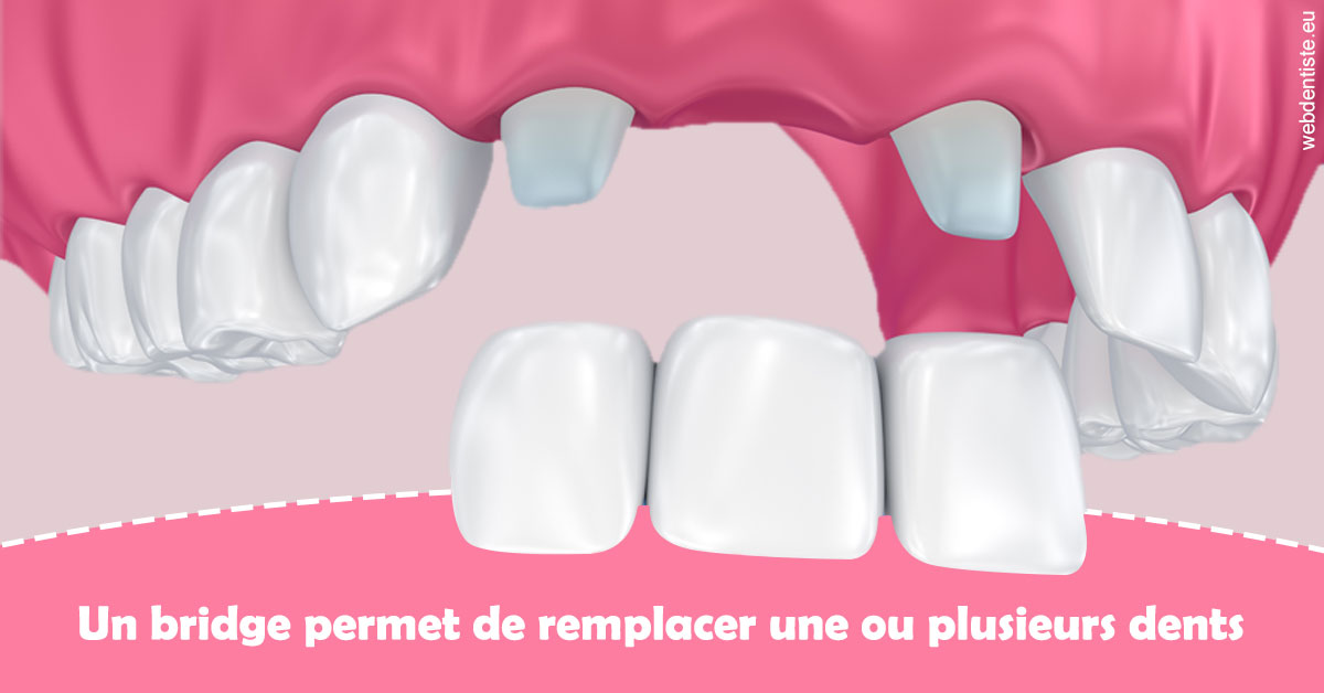 https://www.dr-dorothee-louis-olszewski-chirurgiens-dentistes.fr/Bridge remplacer dents 2