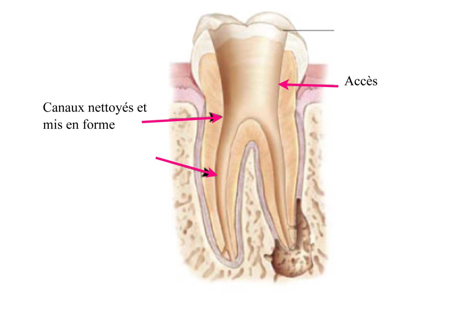 Comment-se-déroule-un-traitement-endodontique_-3