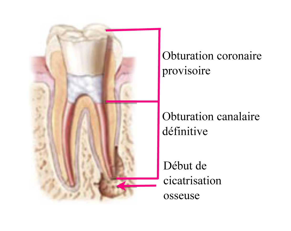 Comment-se-déroule-un-traitement-endodontique_-4
